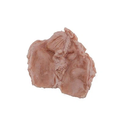 Duodenal Ulcer Pathology Specimen