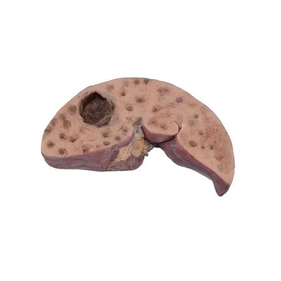 Liver Cancer Model